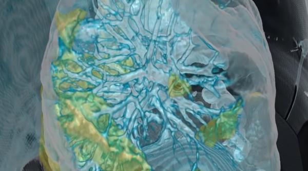 scanare 3d cum arata plamanii unui infectat cu covid 19 pacientul nu suferea de alte boli