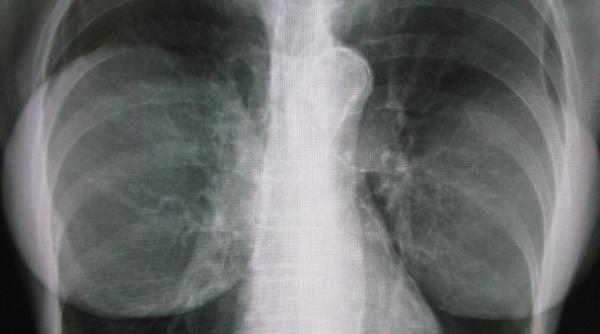 femeie impuscata in piept salvata de implantul mamar cum a fost posibil