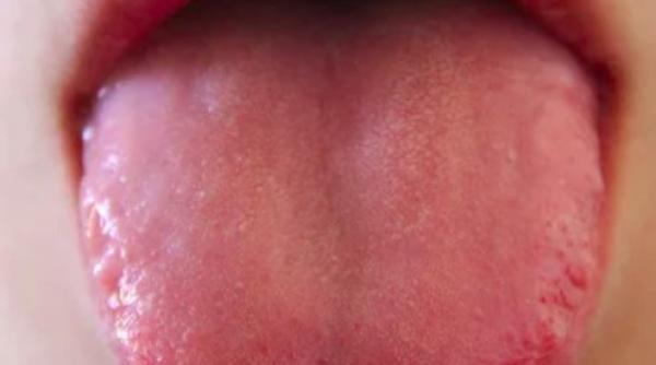 culoarea limbii tradeaza boli cardiace atentie la aceasta nuanta