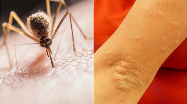 cum scapi de intepaturile de tantar trucul genial dezvaluit de un medic