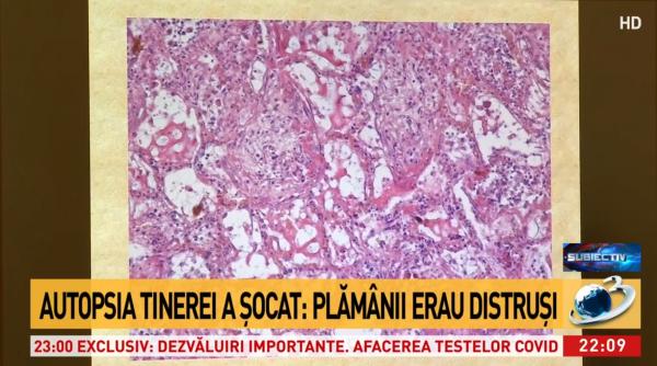 cum arata plamanii tinerei de 30 de ani care a murit de covid