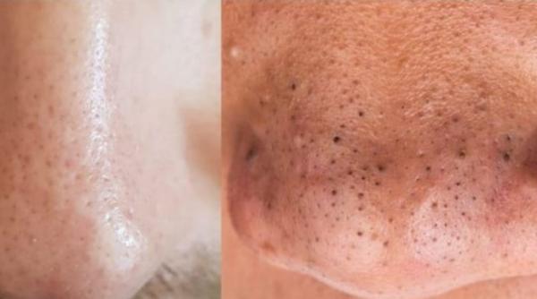 puncte negre vs filamente seboreice ce sunt si care e diferenta dintre ele pe intelesul tuturor