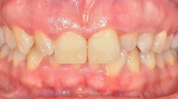 problema dentara ce are legatura cu alzheimer