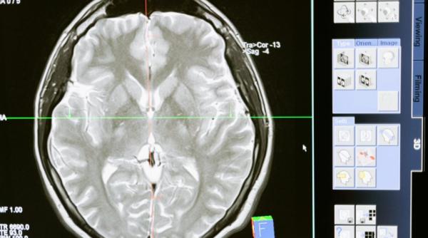 progres urias in tratarea tumorilor cerebrale rezultate rar intalnite atat de timpuriu