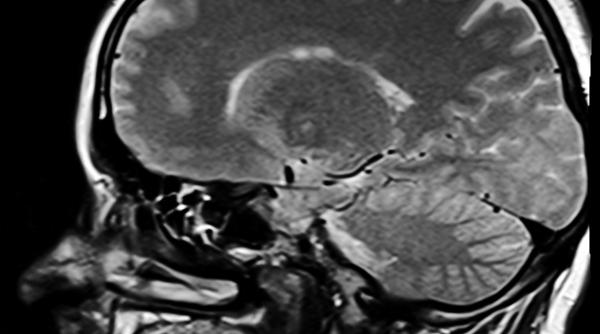 studiu afectiune neurologica rara legata de infectarea cu sars cov 2 in 21 de tari