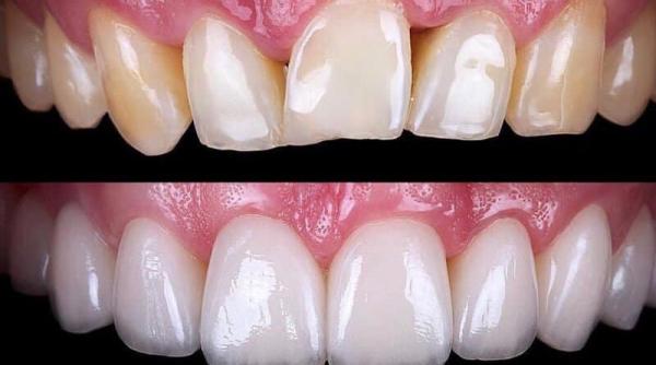 riscuri la care te expui cand iti faci acasa albire dentara