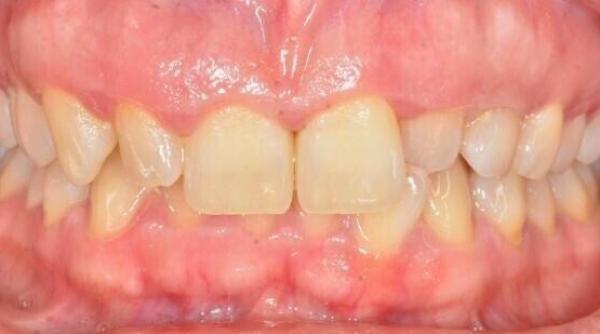 cum prevenim sangerarile gingivale atentie va puteti pierde dintii video