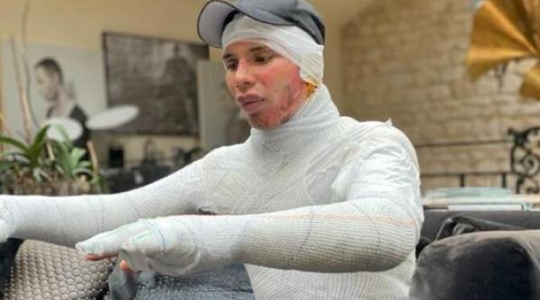 olivier roustening primele imagini dupa ce a fost ars este infasurat in bandaje