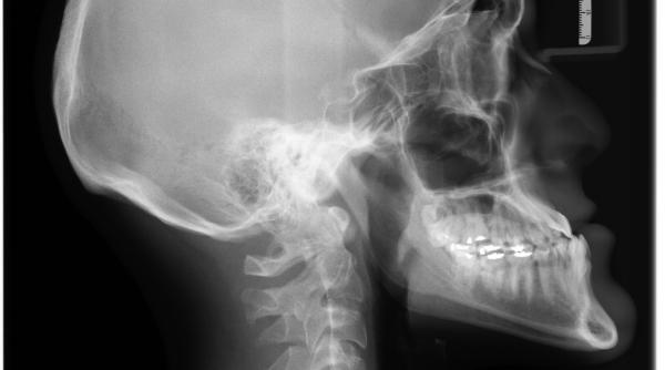 un barbat care suferea de convulsii misterioase diagnosticat cu un parazit ce traia in creierul lui de zeci de ani