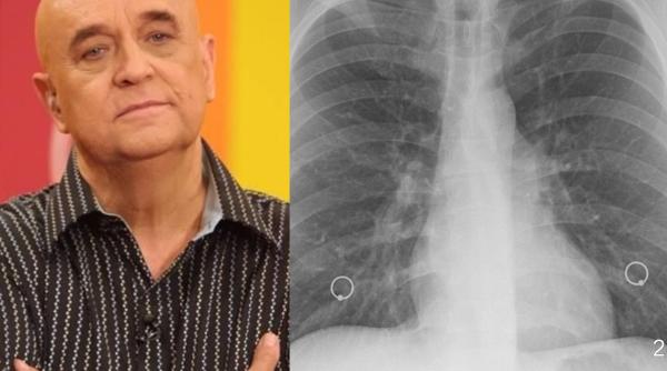 ce este pneumonia de aspiratie boala care l a ucis pe benone sinulescu obiceiul zilnic care ne poate costa arde plamanul