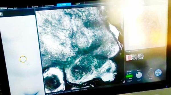 costel fotea premiera la galati cancerul de piele depistat cu ajutorul unui tomograf