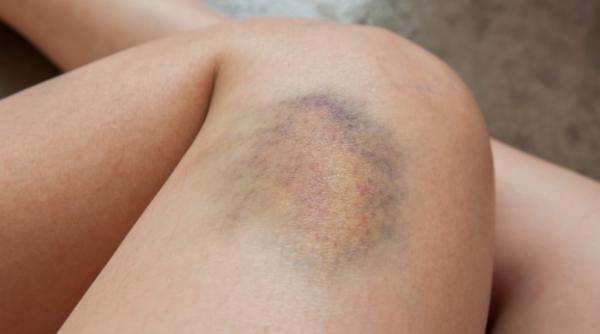 vanatai pe picioare de ce apar si cum le poti trata rapid