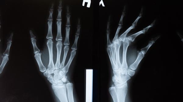 radiografia unei supravietuitoare de la bataclan scoasa la vanzare ca nft chirurgul ar putea fi pus sub acuzare