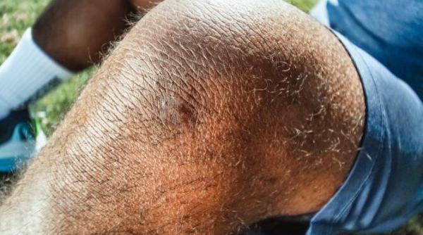 ruptura de menisc blestemul fotbalistilor cum se ajunge de la durerea ascutita in genunchi la bisturiu dr razvan dragomir e ca pietricica din pantof care ne jeneaza