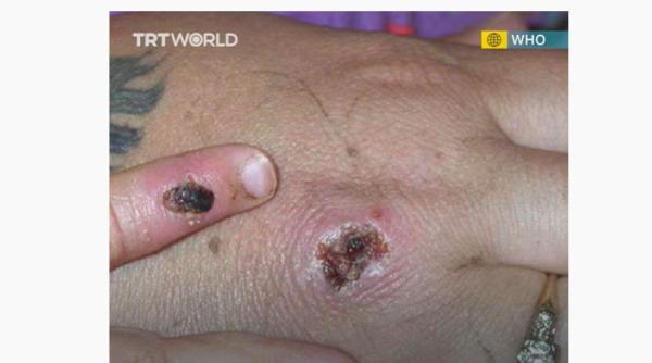 sapte cazuri de infectare cu variola maimutei in marea britanie oms ramane un risc de transmitere continua in aceasta tara