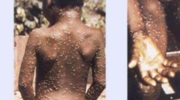 variola maimutei ce este si cum poti sa te infectezi