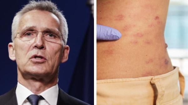 ce este zona zoster boala din cauza careia jens stoltenberg nu mai vine in romania