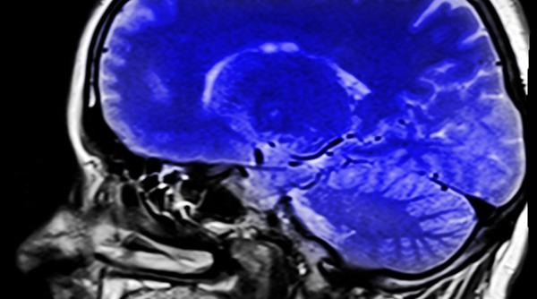 anorexia micsoreaza creierul arata un nou studiu
