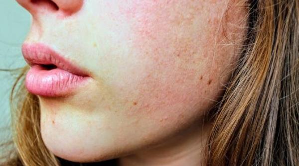 ai acnee pete sau cicatrici pe ten specialistul ioana marinescu iti spune cum sa ajungi la un ten perfect e atat de simplu video