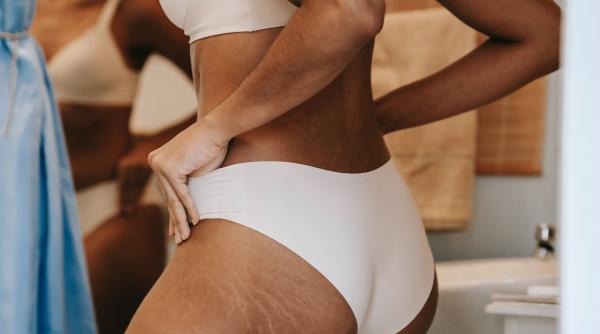 ce sunt vergeturile si cum sa le tratezi