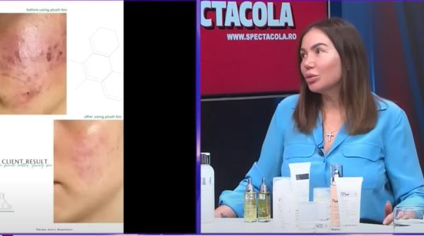 ce trebuie sa adaugi in rutina ta daca ai un ten cu probleme cum scapi de semnele lasate de cosuri video