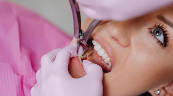 demineralizarea dintilor cauze si semnul la care sa ai grija avertismentul specialistului