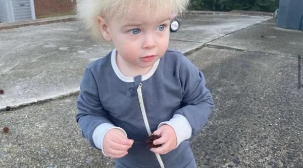 sindromul parului ciufulit declansat de mutatii genetice afecteaza doar copiii