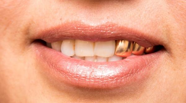 ce se intampla cu dintii de aur in timpul incinerarii pot fi recuperati