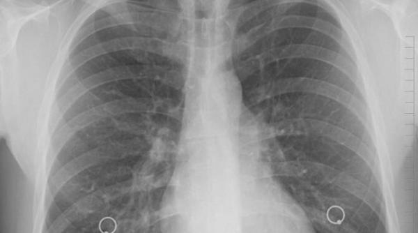 program de depistare activa a tuberculozei demarat de ministerul sanatatii in 11 judete cresc sansele de vindecare ale pacientilor