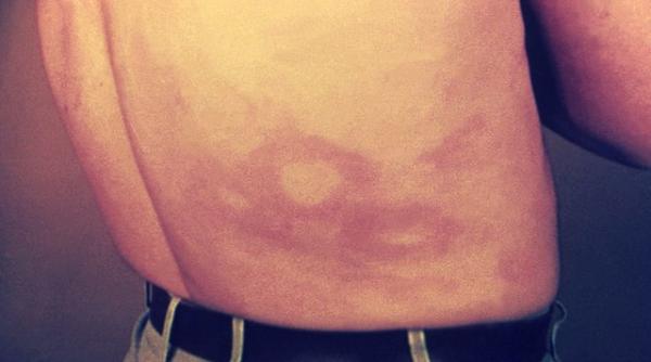 lepra o boala considerata medievala inca mai inregistreaza cazuri insa ar putea fi raspunsul unor maladii actuale