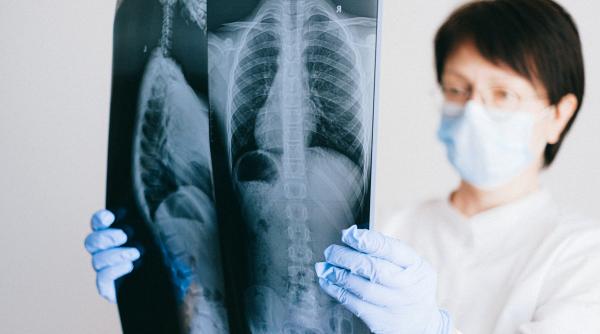 din ce in ce mai multe cazuri de tuberculoza medicii atrag atentia