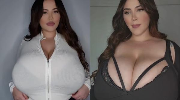 femeia diagnosticata cu o afectiune foarte rara sanii imi cresc dramatic din cauza unei boli