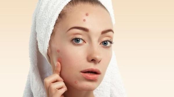 ghimbirul trateaza acneea tonifica intinereste si hraneste pielea afla cum il poti folosi