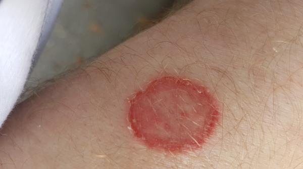 in sua au fost raportate primele cazuri de pecingine severa rezistenta la antibiotice