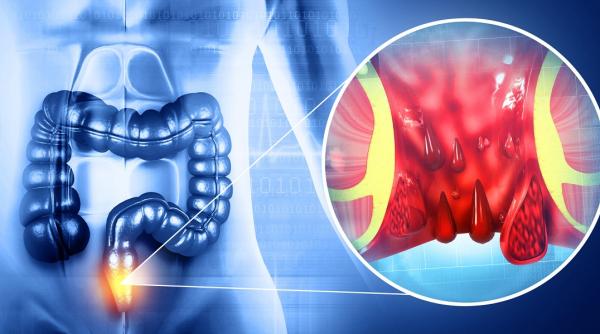 ce sunt hemoroizii si care sunt motivele aparitiei acestora cum se trateaza