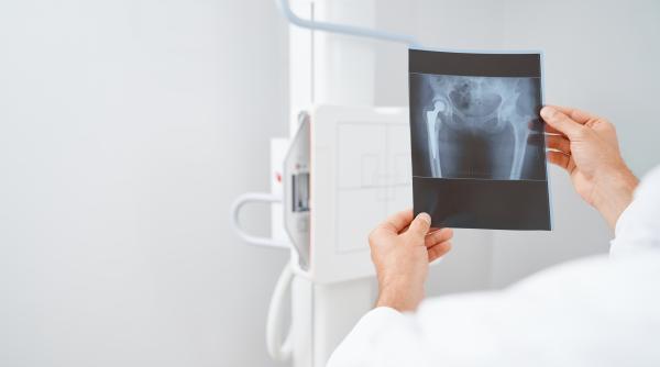 complicatiile postoperatorii de care medicii se tem care este procentul de mortalitate in cazul fracturilor de bazin video