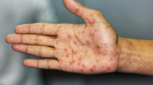 cazurile de sifilis au crescut cu 128prc in randul femeilor din capitala unui stat american