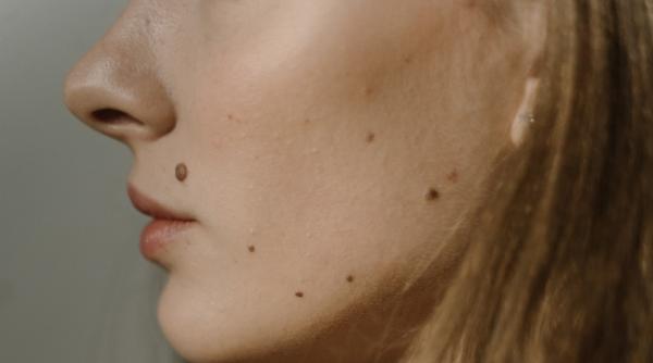 cum deosebesti o alunita sanatoasa de o alunita periculoasa cum recunosti un melanom mihaela leventer evolueaza tacut fara simptome