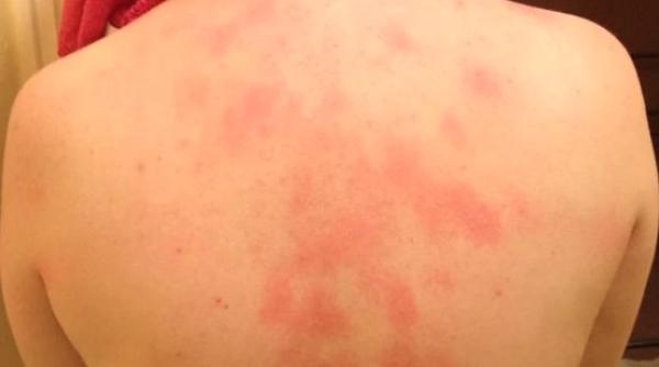 ziua internationala a urticariei 1 octombrie 2023 boala care nu te lasa sa traiesti