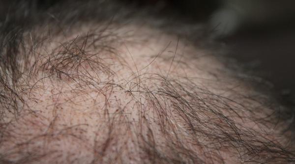 solutiile de aur pentru caderea parului ce sa faci pentru a nu avea nevoie de transplant