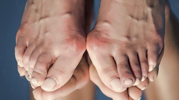 montul afectiunea picioarelor data de moda dr codrin huszar sanador este un factor favorizant are nevoie si de niste mici particularitati