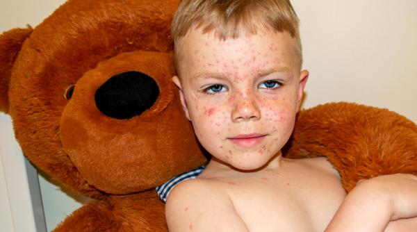 epidemia de rujeola din romania situatie alarmanta dr adrian marinescu e fara precedent se poate ajunge si la deces