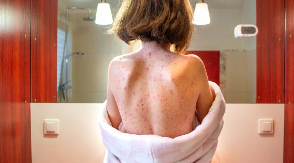 alerta de rujeola in anglia ar putea aparea un focar de pana la 160 000 de cazuri in lipsa vaccinarii