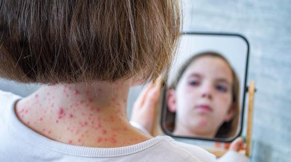 aproape 400 de cazuri de rujeola inregistrate in ultima saptamana in romania