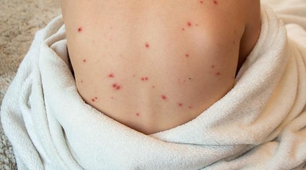 sase focare de varicela in scolile din olt dsp olt toate cazurile sunt usoare