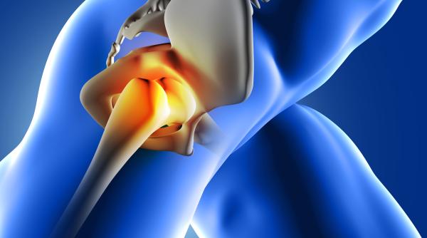 cand fractura de sold ne poate pune viata in pericol dr razvan dragomir sanador risc mare de necroza daca nu se intervine rapid e zona cu cea mai proasta vascularizatie