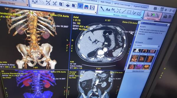 galati soft pe baza de inteligenta artificiala pentru tratarea cancerului