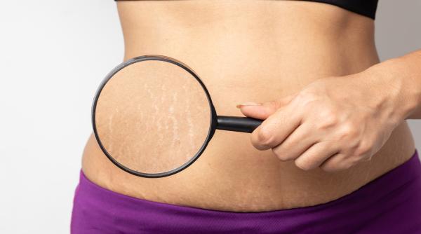 prof dr ioan lascar totul despre vergeturi cum pot fi corectate de fapt liposuctia e periculoasa aflam si acest raspuns daca vrem un abdomen plat video