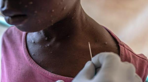 india confirma un caz izolat de mpox fara legatura cu varianta care a declansat alerta globala a oms