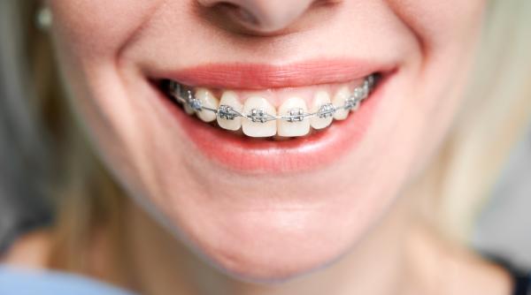 aparat dentar tipuri beneficii si preturi in 2025